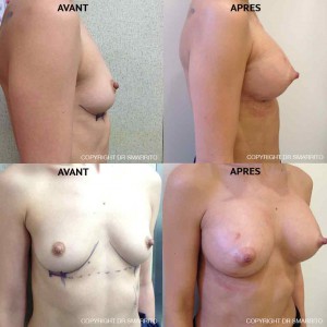 Photographies Avant Après d'augmentation mammaire avec prothèses anatomiques 300 cc