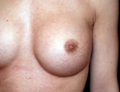 Cicatrice d'augmentation mammaire de type micro-cicatrice autour du téton