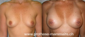 Pose de prothèses mammaires 