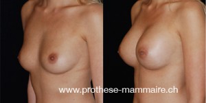 Pose de prothèses mammaires par Dr Smarrito