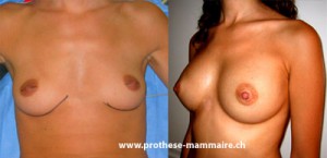 prothèses mammaire s avec un effet naturel